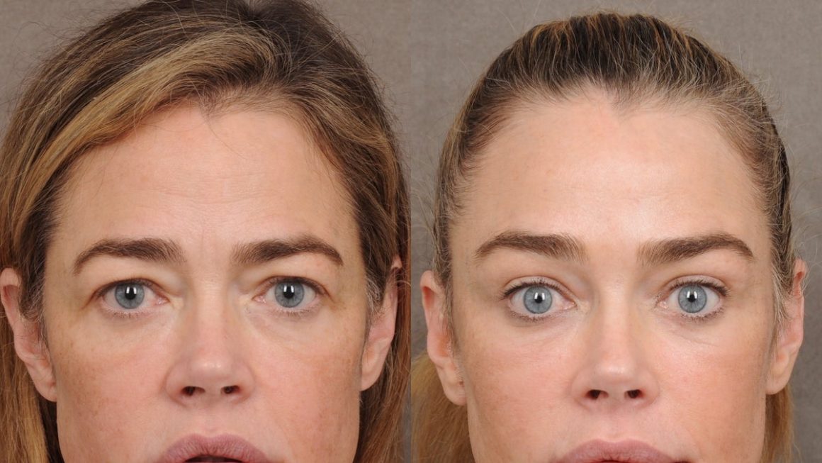 Denise Richards Reveals Facelift Details Amidst Personal Struggles
