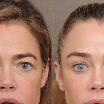 Denise Richards Reveals Facelift Details Amidst Personal Struggles