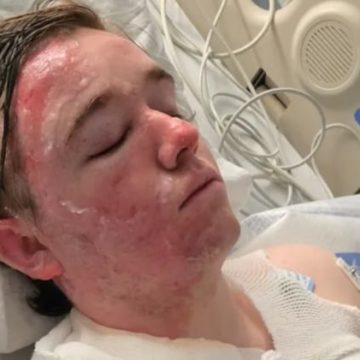 California McDonald’s Employee Suffers Severe Burns in Workplace Incident