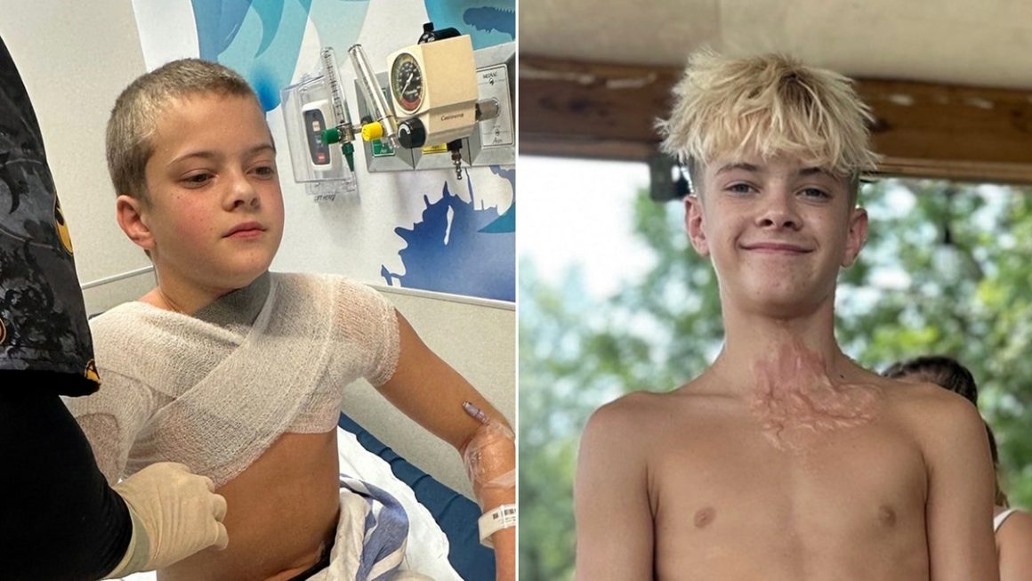Viral TikTok Trend Results in Severe Burns for Alabama Teen