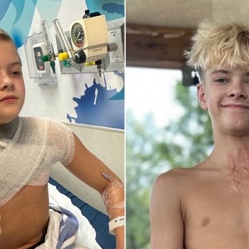 Viral TikTok Trend Results in Severe Burns for Alabama Teen