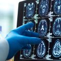 New Glioblastoma Therapy Explores Novel Attack Strategies