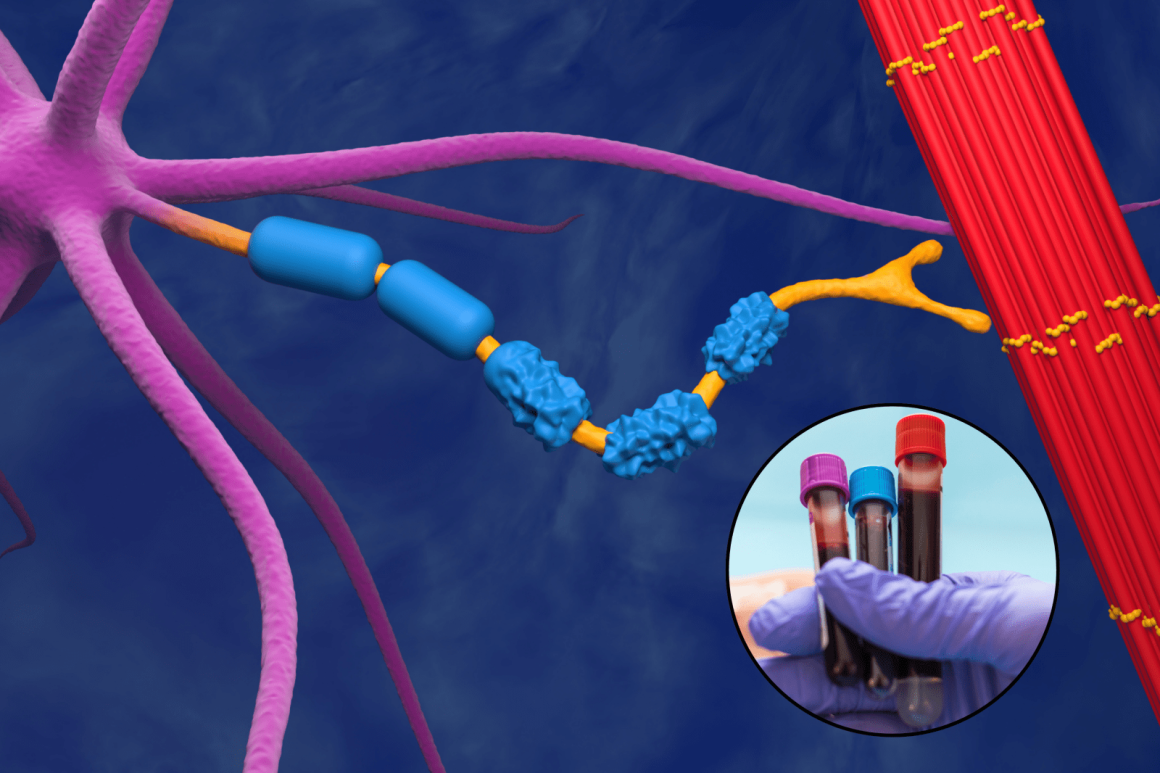 Breakthrough in ALS Research: Early Detection through Blood Proteins