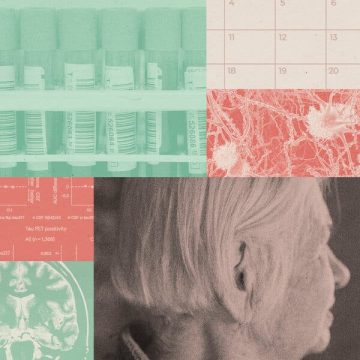 Blood Tests Show Promise in Alzheimer’s Diagnosis and Risk Prediction