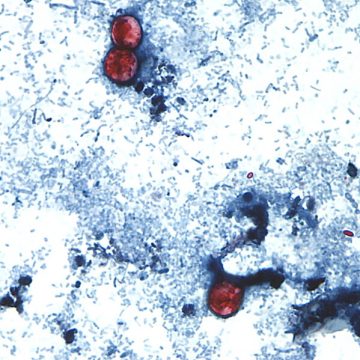 FDA Investigates Cyclospora Outbreak Linked to Lettuce