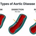 Understanding Aortic Health: A Look into Aortic Disease and Prevention