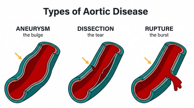 5197a3e6-11a1-4e85-a659-6b04ec45c9f2 Understanding Aortic Health: A Look into Aortic Disease and Prevention