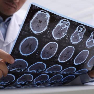 Impact of Early-Life Sugar Consumption on Alzheimer’s Risk