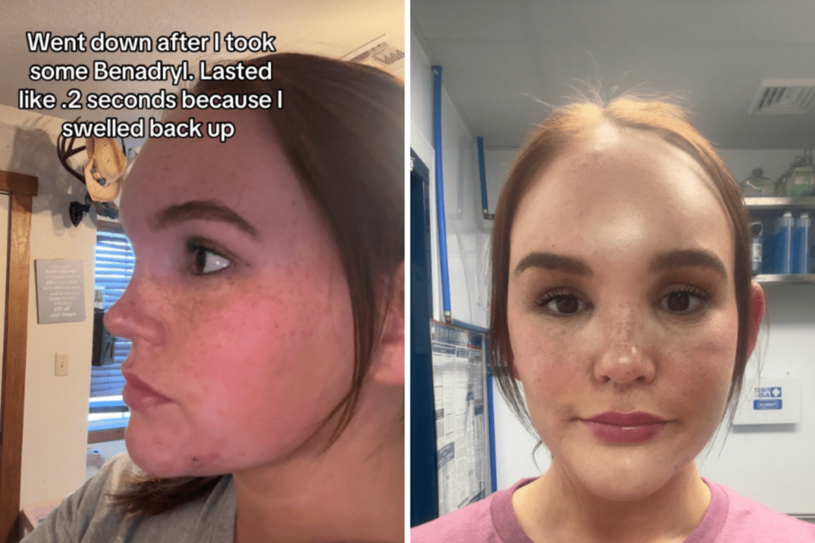 6c96f1cd-0fbb-4a3b-b09c-febe4a865afd Oklahoma Woman’s Bug Bite Leads to Medical Crisis
