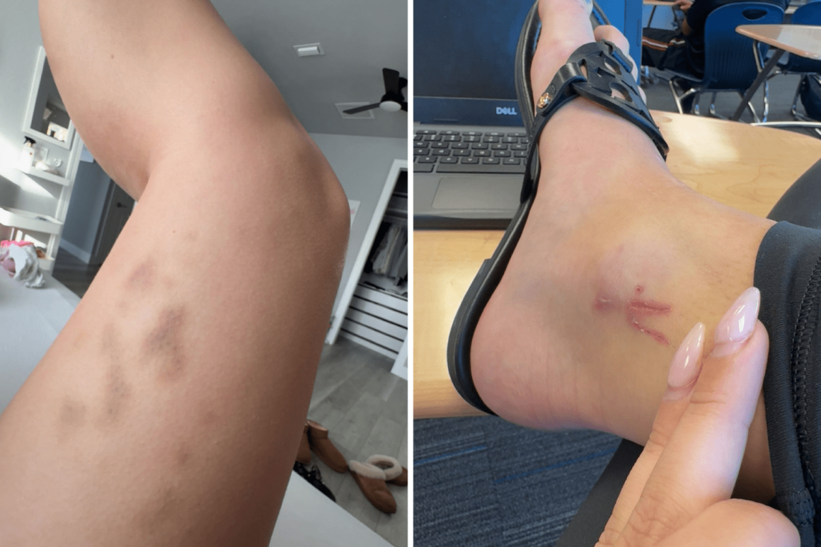 An 18-Year-Old’s Journey with Hodgkin’s Lymphoma