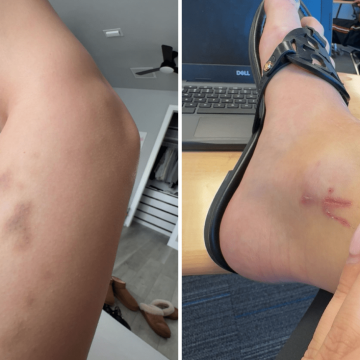 An 18-Year-Old’s Journey with Hodgkin’s Lymphoma