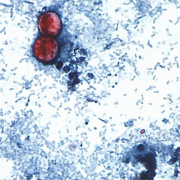 Cyclospora Outbreak in the U.S. Expands to More States