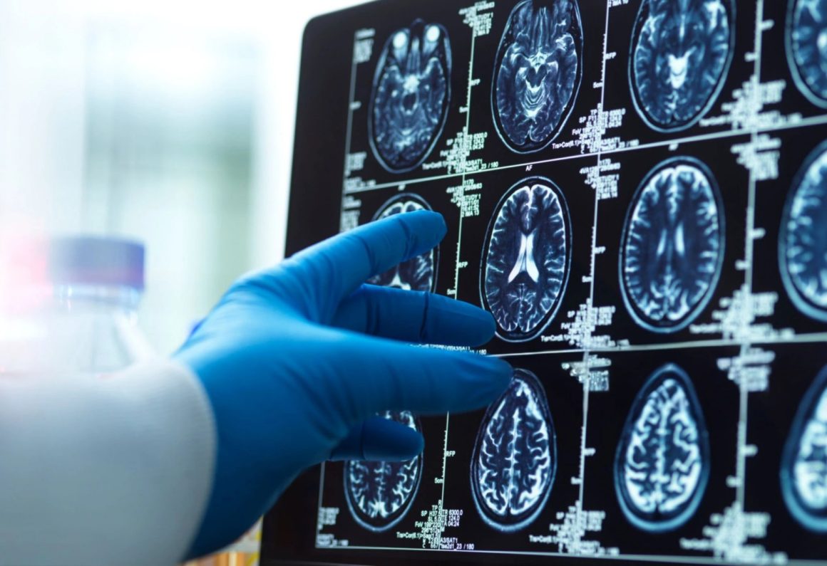 Insights into Alzheimer’s: The Role of Brain Immune Cells