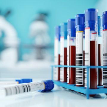 New Research on Blood Sample Analysis for Colorectal Cancer Tracking