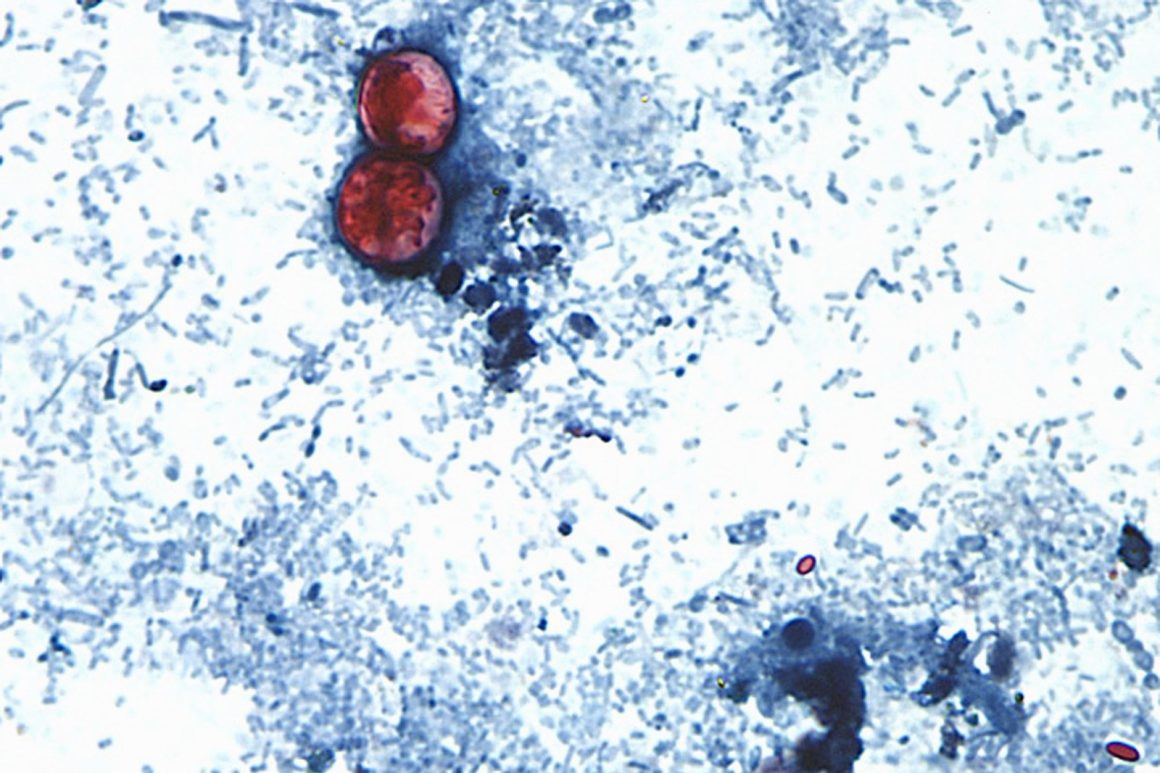 Cyclospora Outbreak Across Multiple States Linked to Iceberg Lettuce