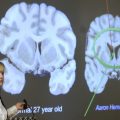 Prevalence and Impact of CTE Among Former NFL Players