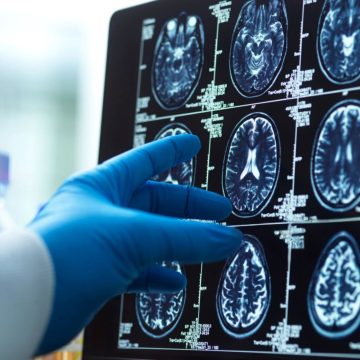 New Insights into Alzheimer’s: Discovery of Mitochondrial Plaques
