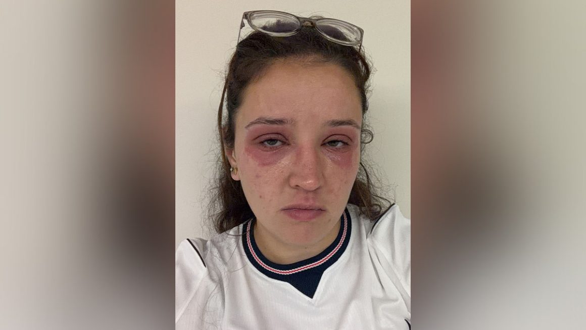Bride Suffers Allergic Reaction to Eyelash Extensions Before Wedding Day