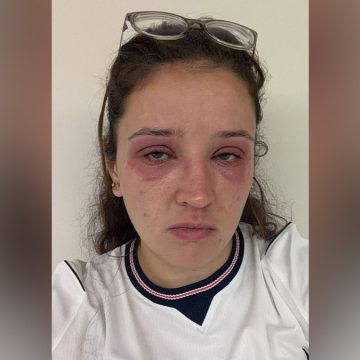 Bride Suffers Allergic Reaction to Eyelash Extensions Before Wedding Day