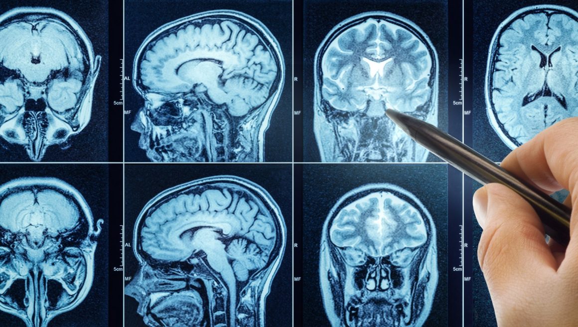Lifestyle Choices and Health Factors Linked to Dementia Risk