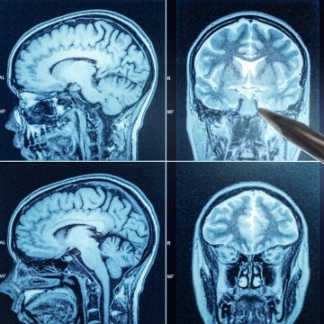 Lifestyle Choices and Health Factors Linked to Dementia Risk