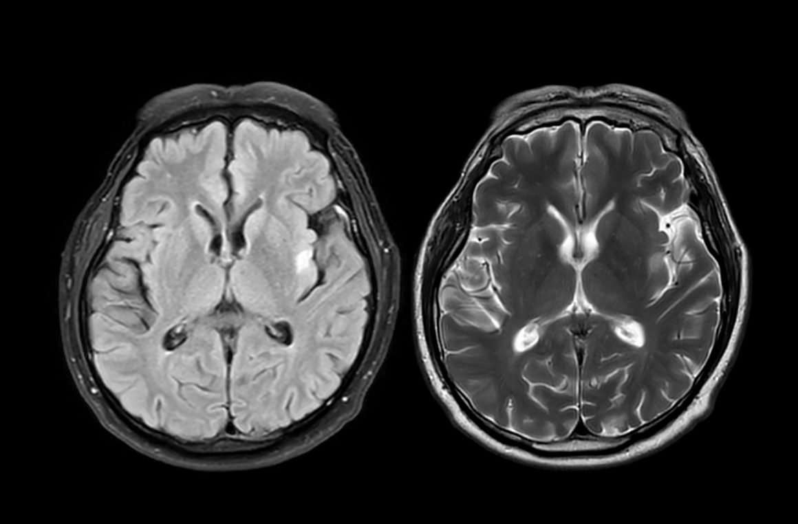 Brain Scan Tool Predicts Alzheimer’s Progression