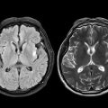 Brain Scan Tool Predicts Alzheimer’s Progression