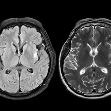 Brain Scan Tool Predicts Alzheimer’s Progression