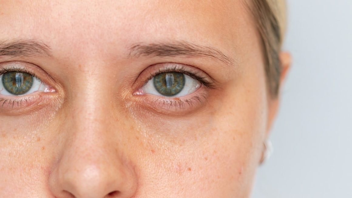 Understanding the Connection Between Dark Under-Eye Circles and Iron Levels