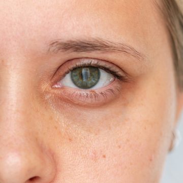 Understanding the Connection Between Dark Under-Eye Circles and Iron Levels