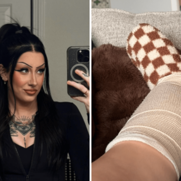 Skin Cancer Warning: A Young Woman’s Story