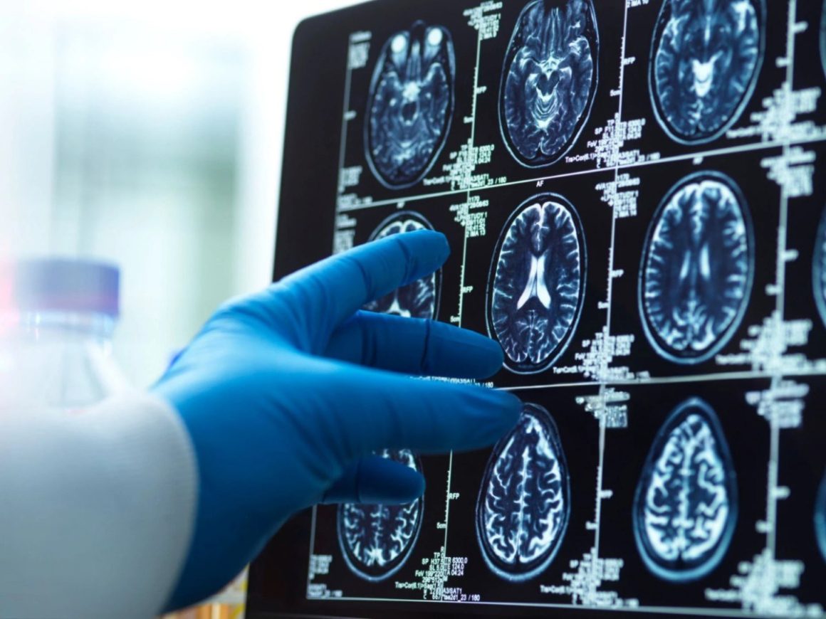 2441c012-d4ac-4e40-bec3-644250f49da8 FDA Approves New Blood Test for Alzheimer’s Diagnosis