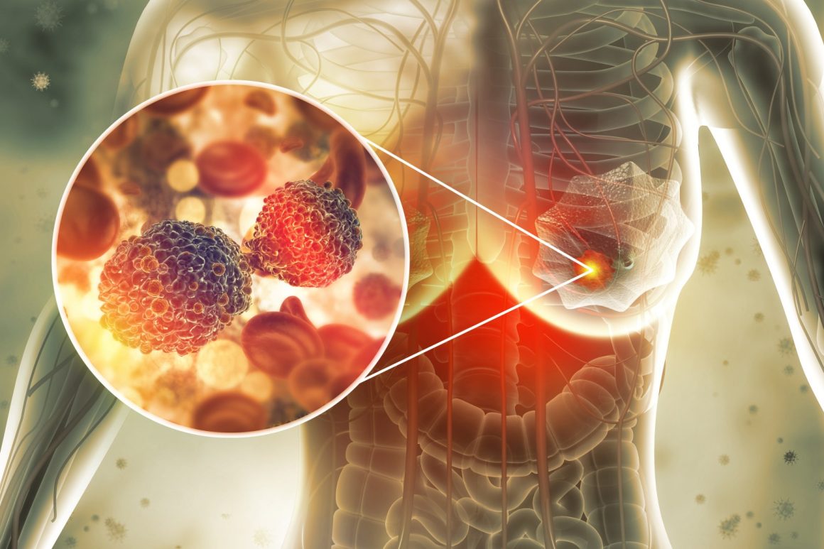 Study Links Dense Breast Tissue to Increased Cancer Risk