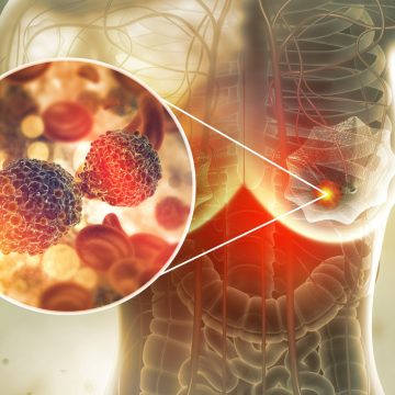 Study Links Dense Breast Tissue to Increased Cancer Risk