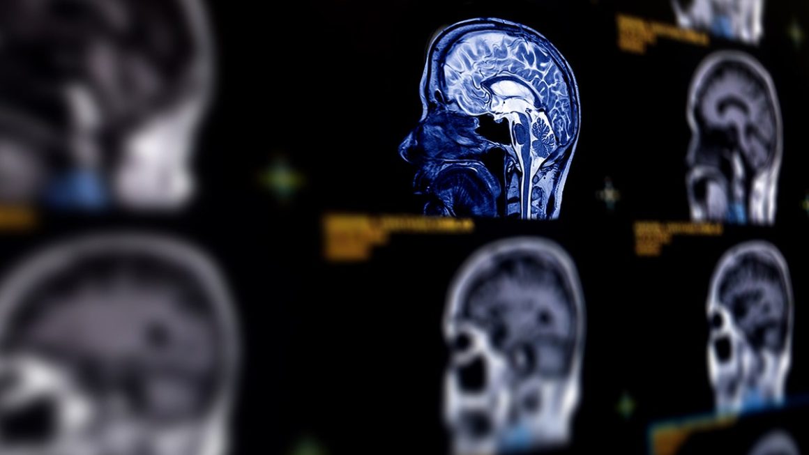 Understanding Memory Lapses in Midlife Women: Hormones or Dementia?