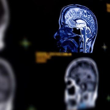 Understanding Memory Lapses in Midlife Women: Hormones or Dementia?