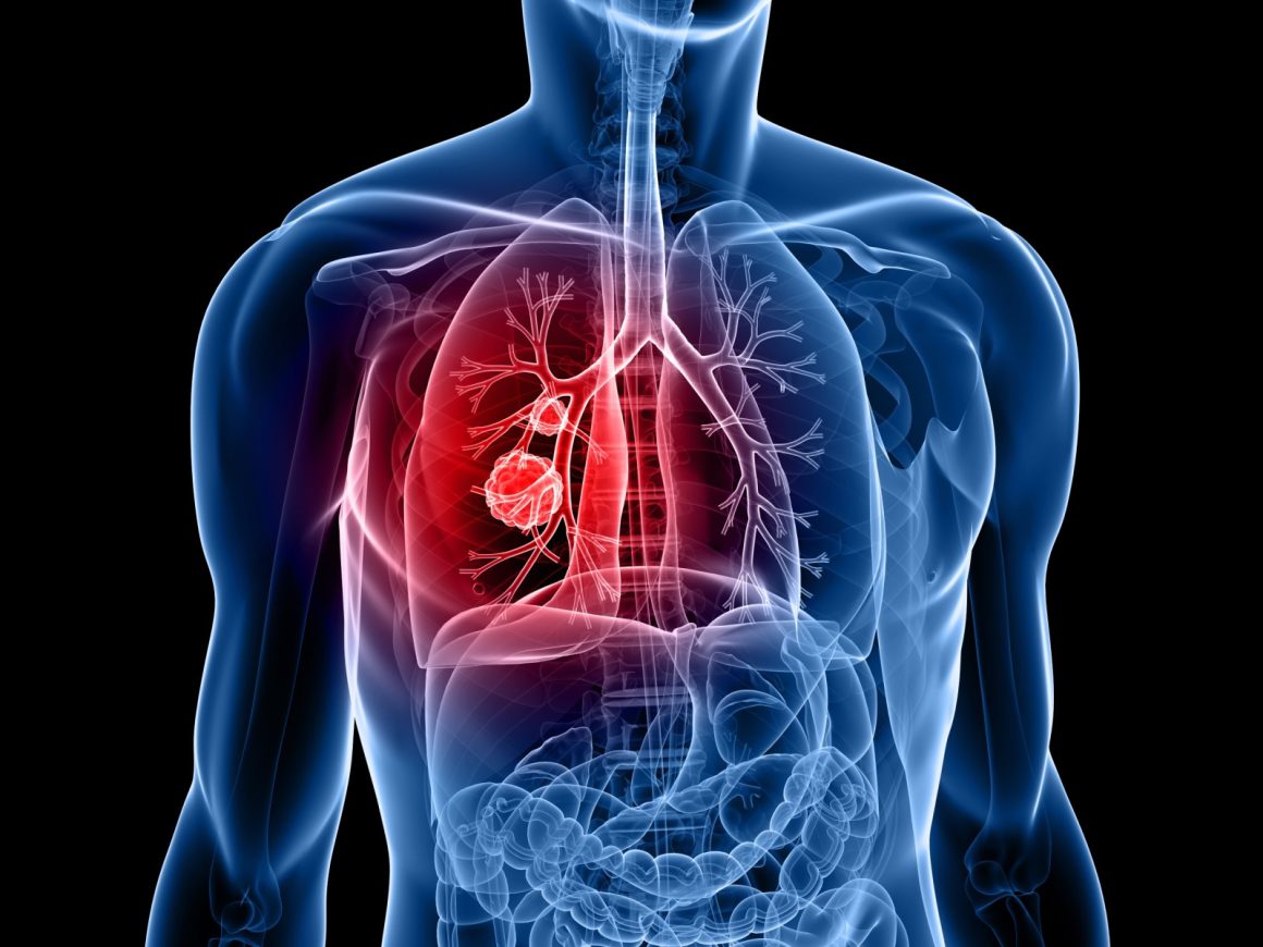 Rare Genetic Mutation Significantly Elevates Lung Cancer Risk in Non-Smokers