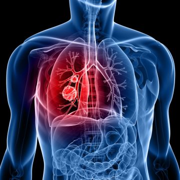 Rare Genetic Mutation Significantly Elevates Lung Cancer Risk in Non-Smokers