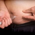 Genetic Links Between Weight-Loss Drugs and Hair Loss