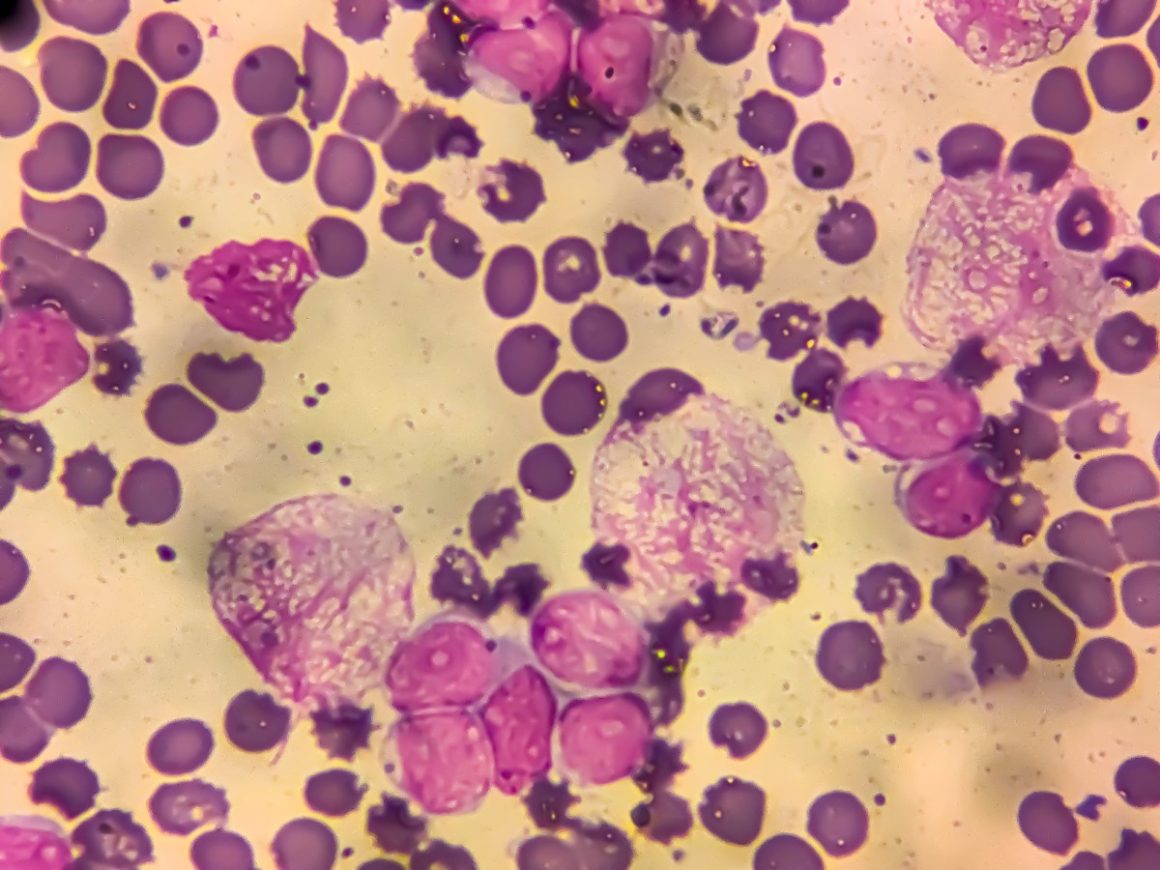 Infections Linked to One in Eight Global Cancer Cases