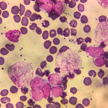 Infections Linked to One in Eight Global Cancer Cases