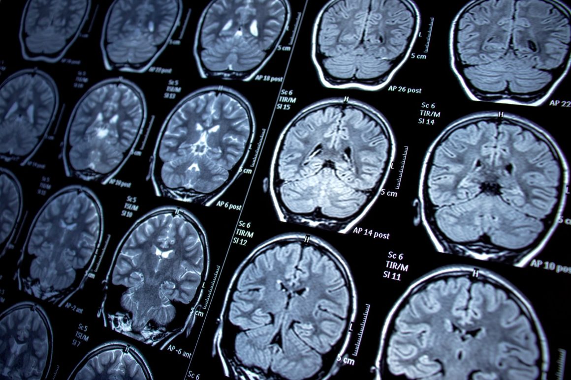 bea0f6f9-429e-4bbf-9ede-1c78ce64e2e8 Innovative Study Explores Restoring Immune Response in Alzheimer’s Disease
