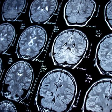 Innovative Study Explores Restoring Immune Response in Alzheimer’s Disease