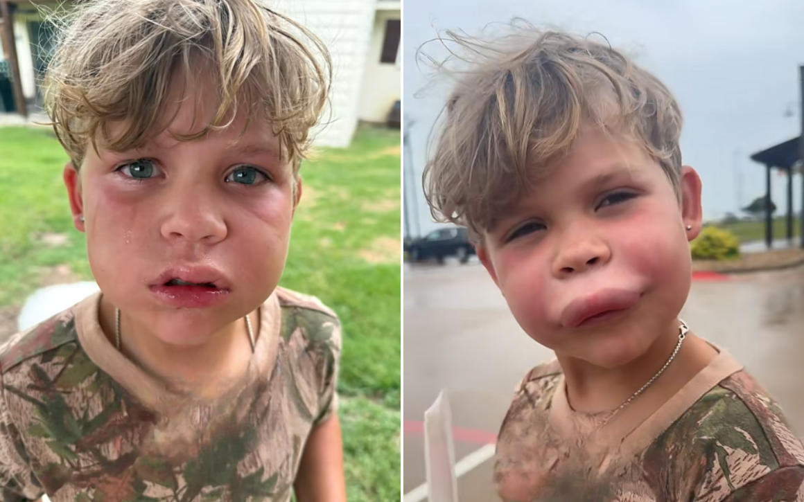 Understanding the Risks of Insect Stings: A Mother’s Experience