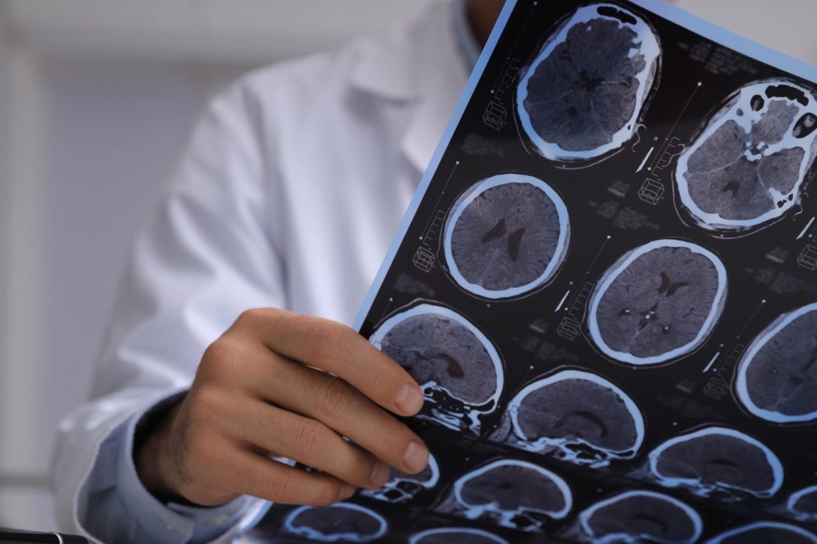 e52a0b3e-7b84-43fe-bb66-783f445e4e60 Early Brain Changes Suggest New Insights into Alzheimer’s Onset