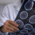 Early Brain Changes Suggest New Insights into Alzheimer’s Onset