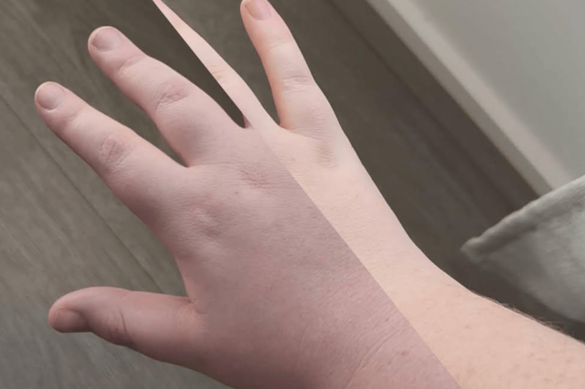Artist Seeks Awareness After Rare Condition Alters Her Life