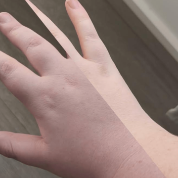 Artist Seeks Awareness After Rare Condition Alters Her Life