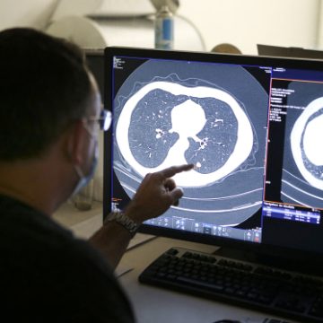 Promise Shown by New Drug in Lung Cancer Treatment