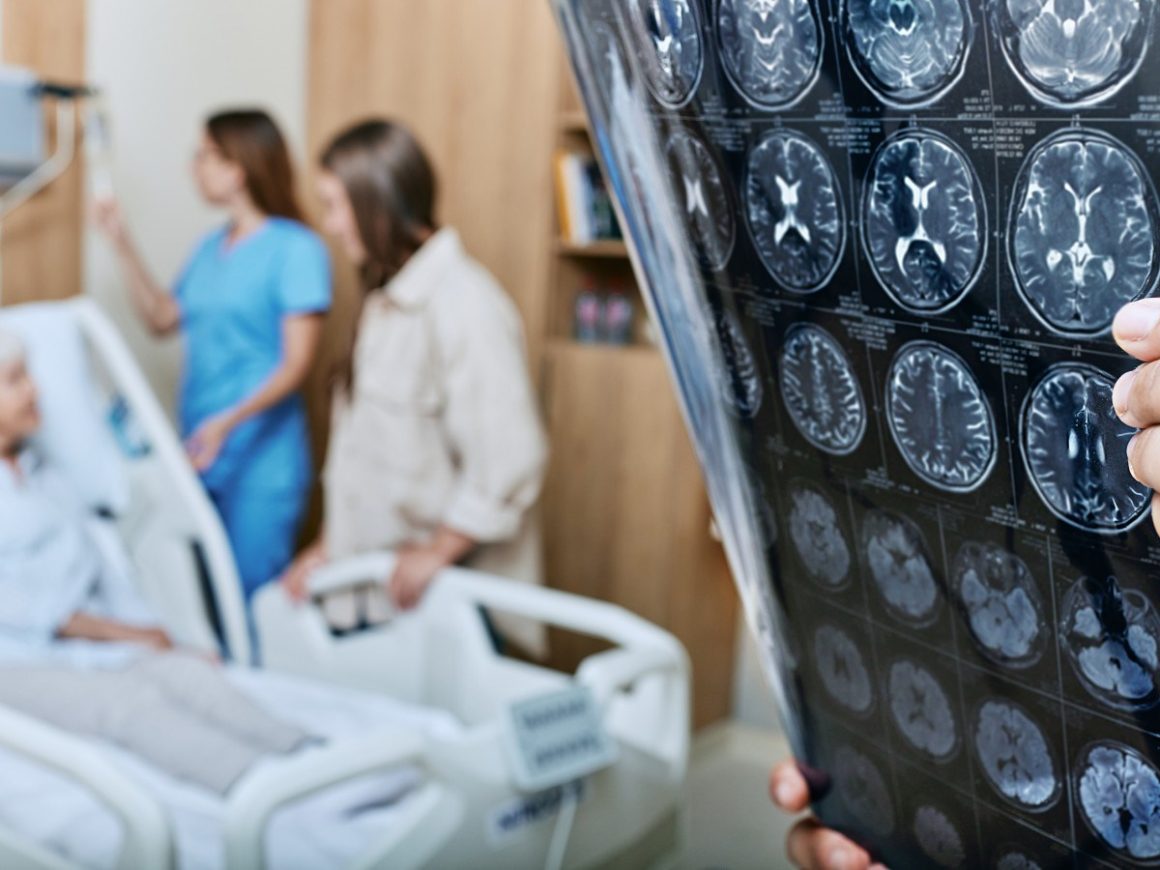 Rising Stroke Rates in Young People: Causes and Prevention
